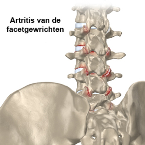 Artritis-van-de-facetgewrichten