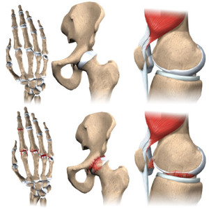 arthritis hand, heup, knie